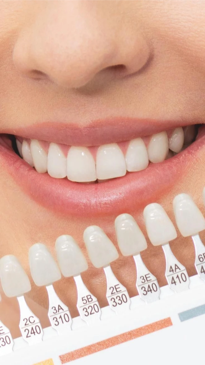 Smile beside a tooth shade guide