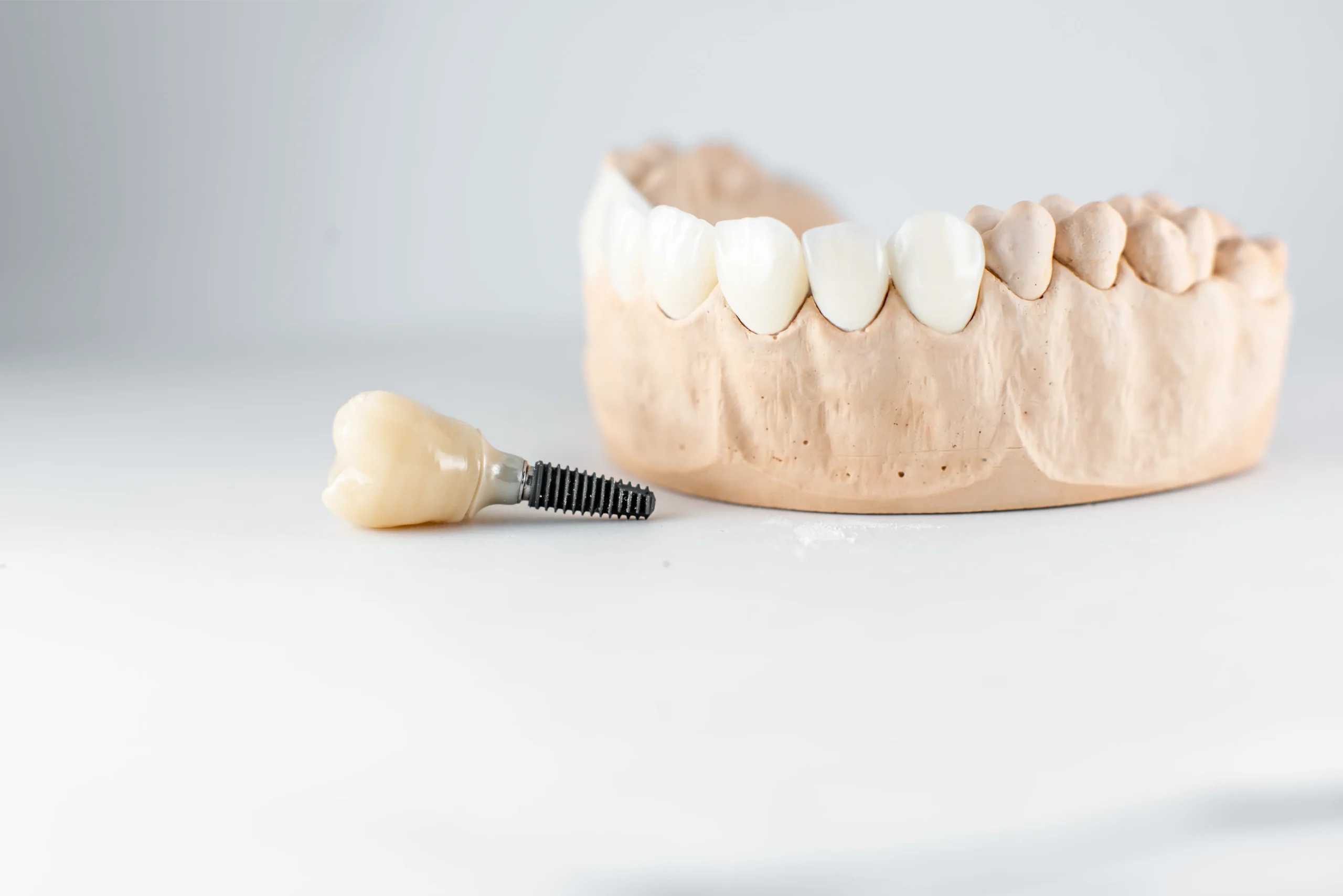 Dental implant and tooth model