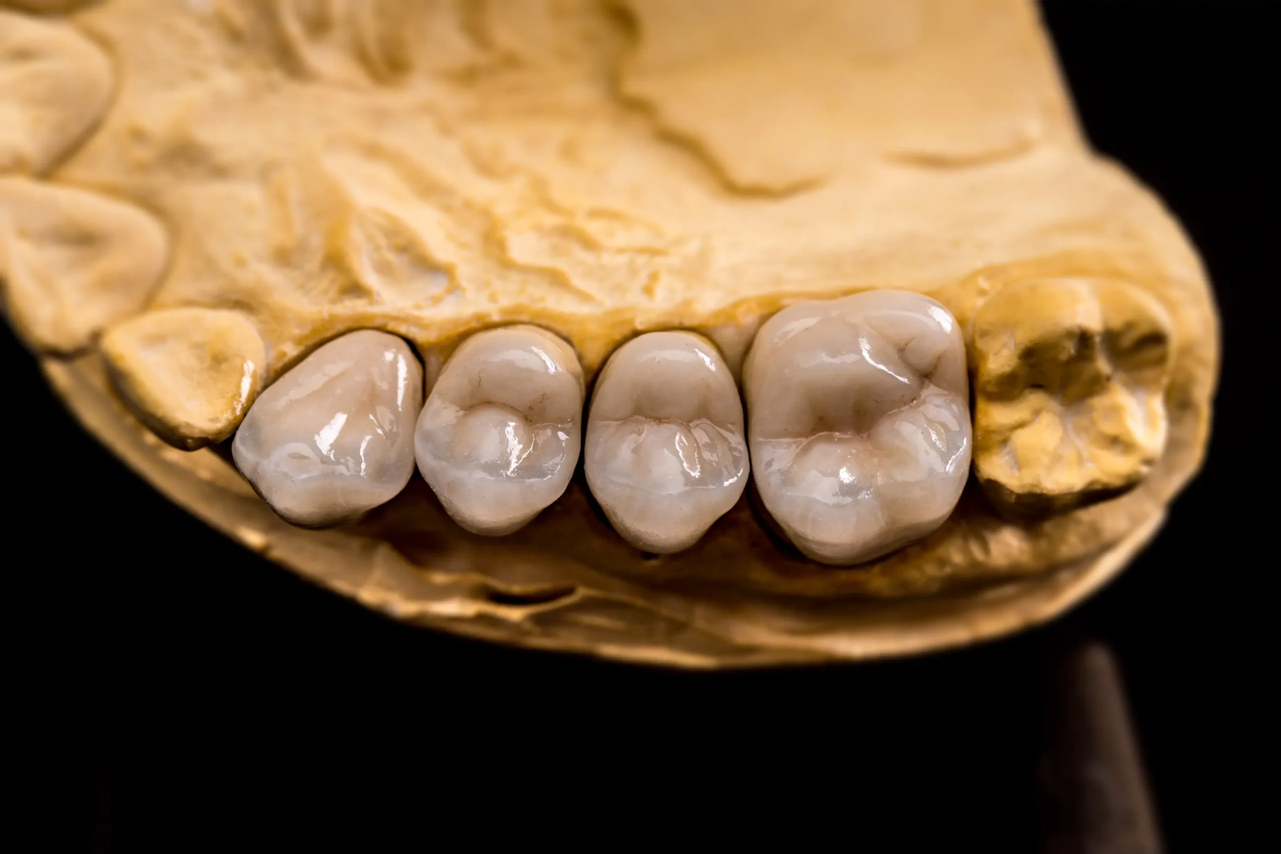 Dental prosthetics model