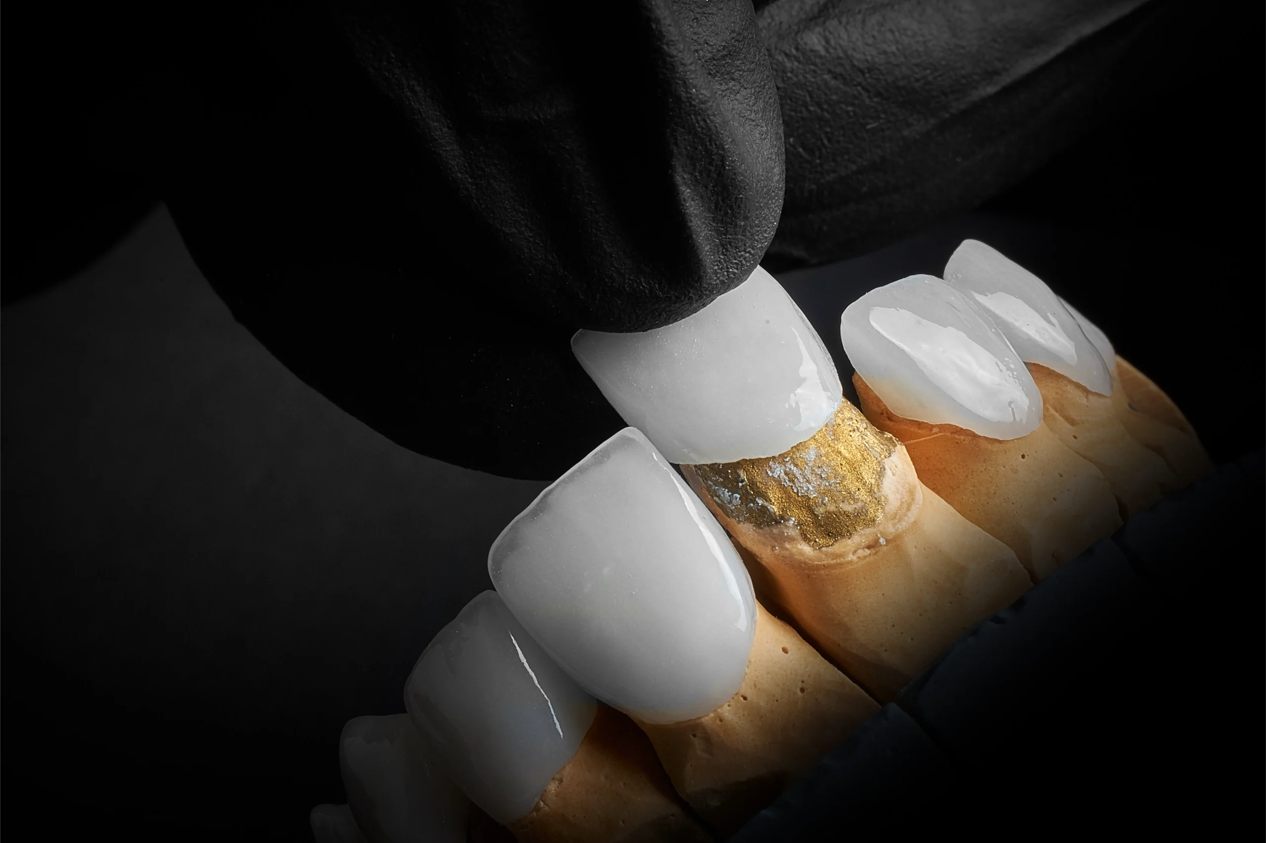 Illustration of veneers being fitted over teeth