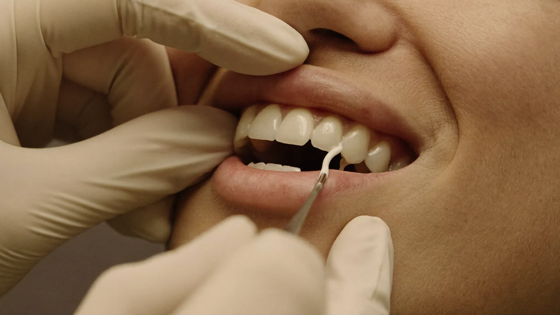 Composite bonding being shaped on a patient's front teeth