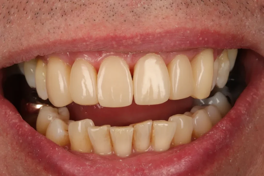 After Bonding with Stable Gum Disease treatment at The Dental Edit