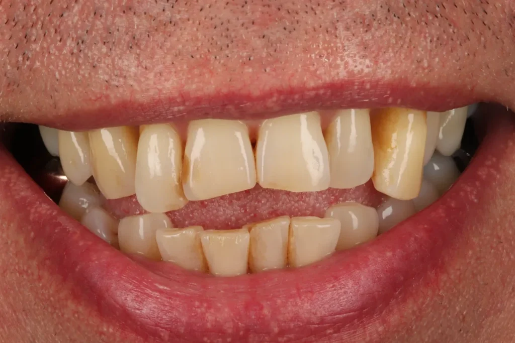 Before Bonding with Stable Gum Disease treatment at The Dental Edit