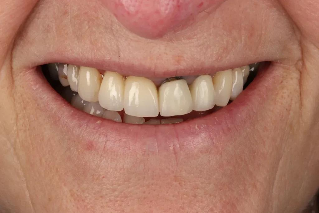 After Broken Tooth Bridge treatment at The Dental Edit