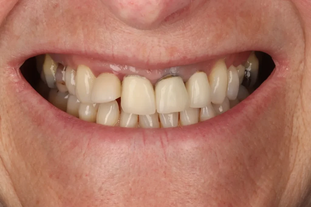 Before Broken Tooth Bridge treatment at The Dental Edit