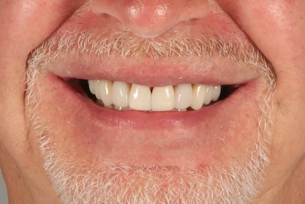 After Composite Bonding treatment at The Dental Edit