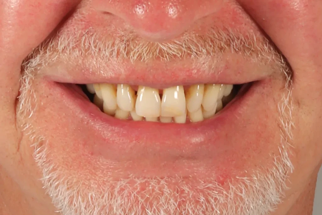 Before Composite Bonding treatment at The Dental Edit