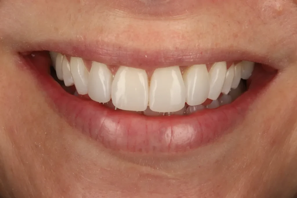 After Composite Bonding treatment at The Dental Edit