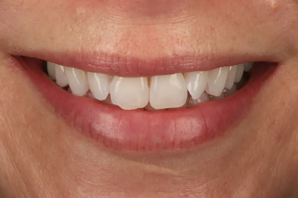 Before Composite Bonding treatment at The Dental Edit