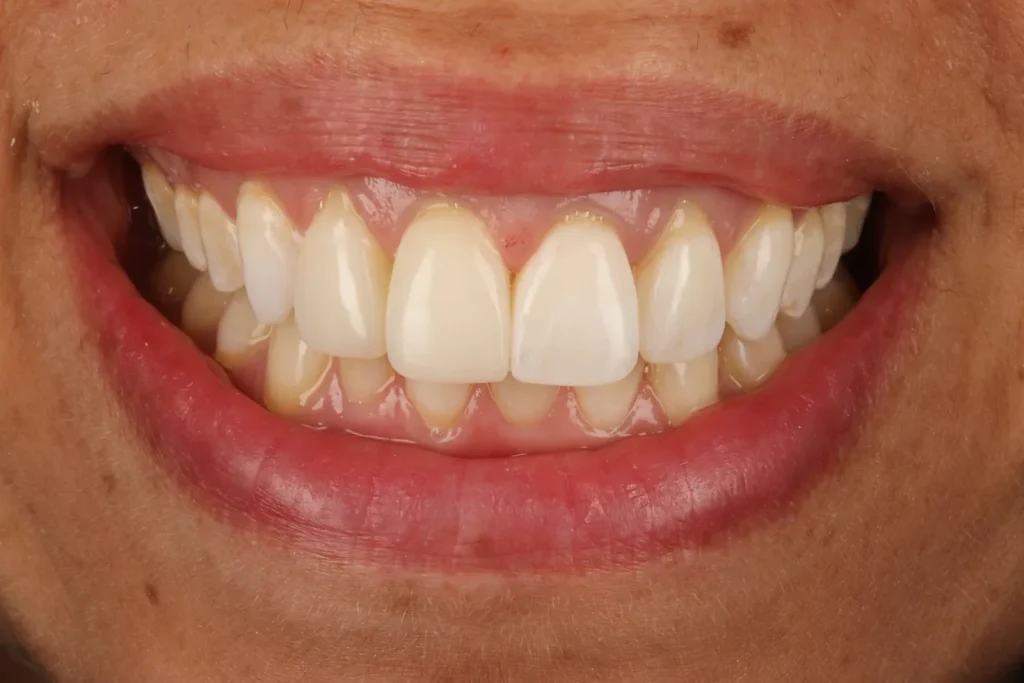 After Composite Bonding treatment at The Dental Edit