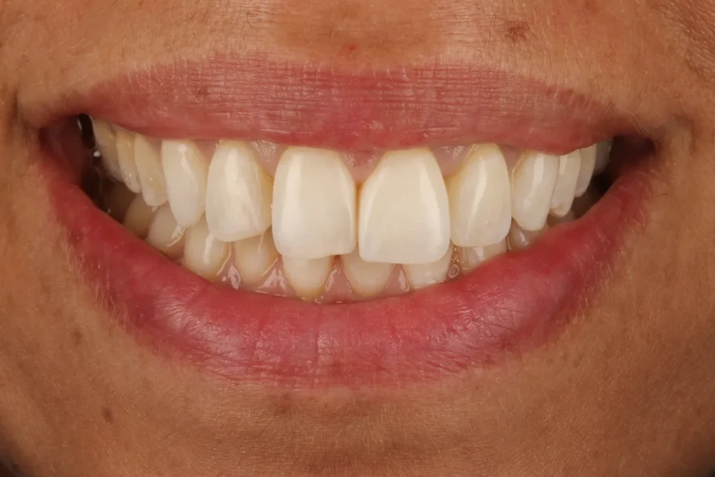 Before Composite Bonding treatment at The Dental Edit