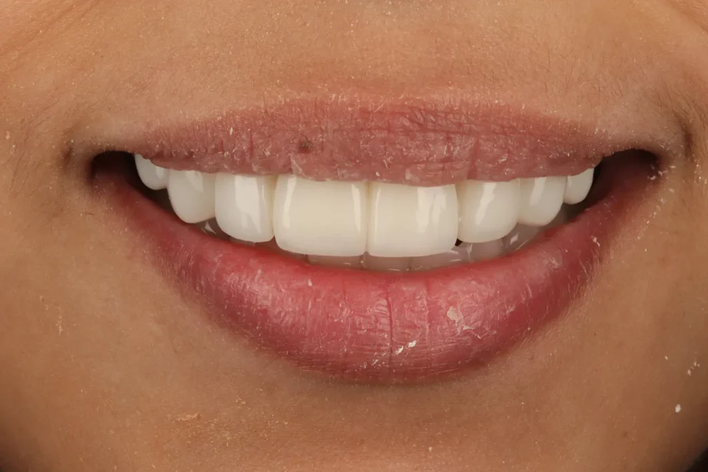 After Composite Bonding and Bridge treatment at The Dental Edit