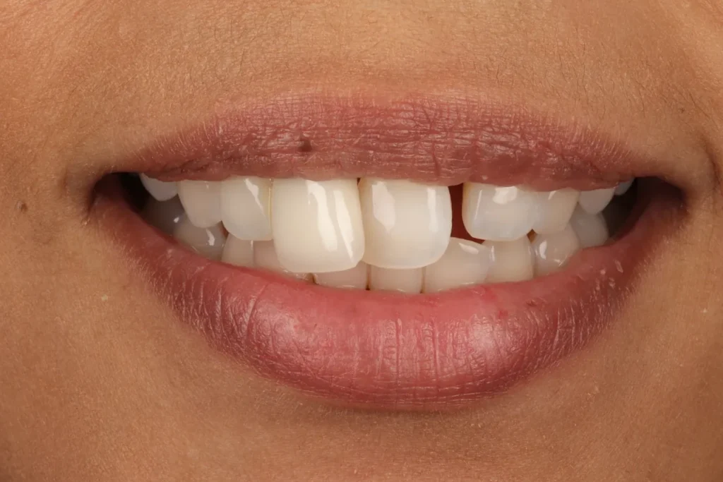 Before Composite Bonding and Bridge treatment at The Dental Edit