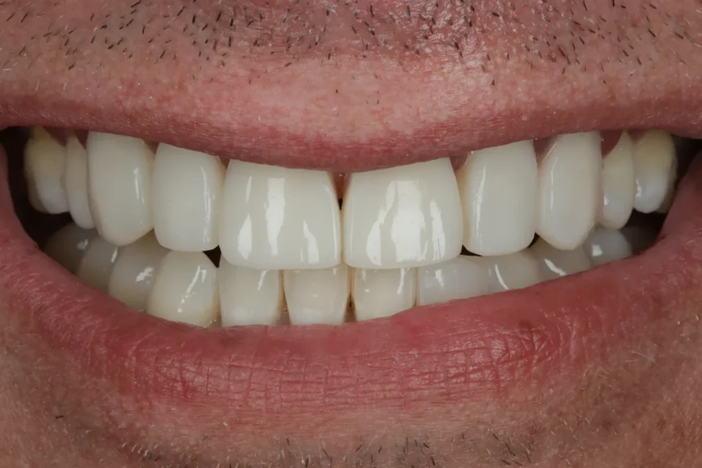 After Composite Bonding and Whitening treatment at The Dental Edit