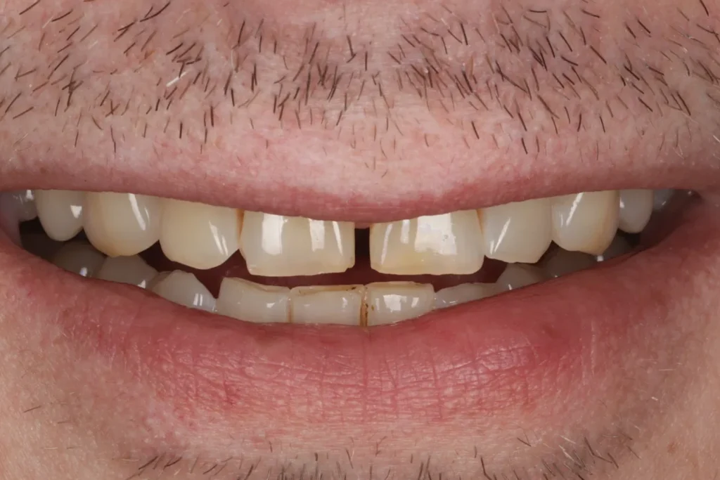 Before Composite Bonding and Whitening treatment at The Dental Edit