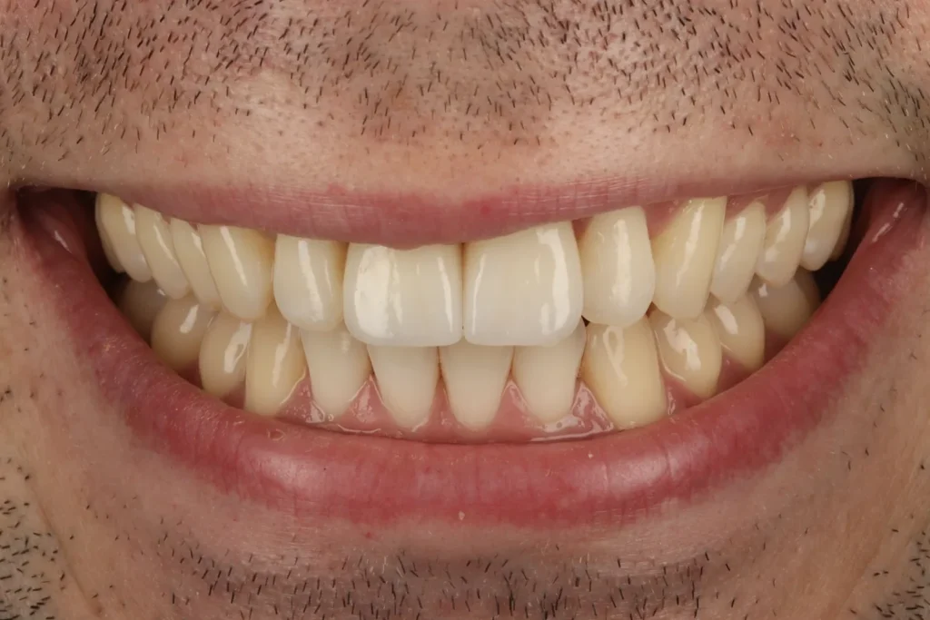 After Dark Tooth treatment at The Dental Edit