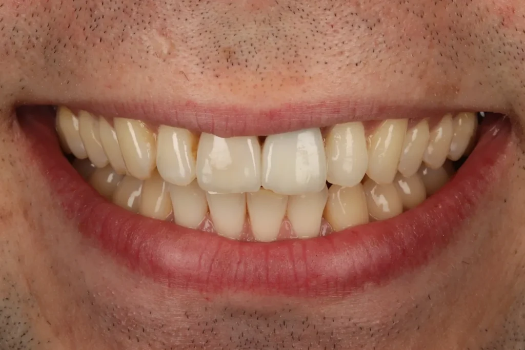 Before Dark Tooth treatment at The Dental Edit