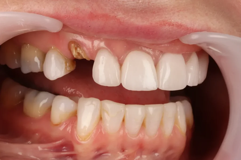 Before Fractured Tooth treatment at The Dental Edit