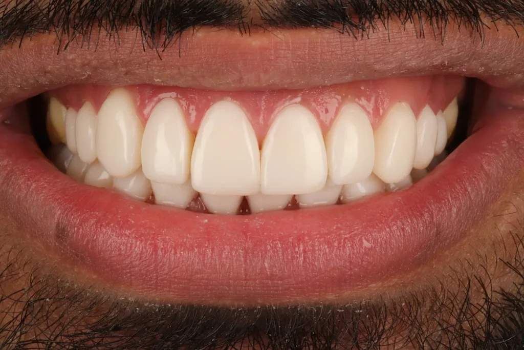 After Full Mouth Composite Bonding treatment at The Dental Edit