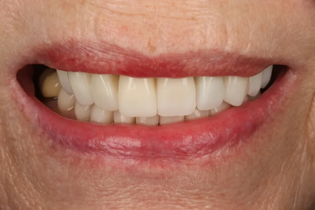 After Full Mouth Rehab treatment at The Dental Edit