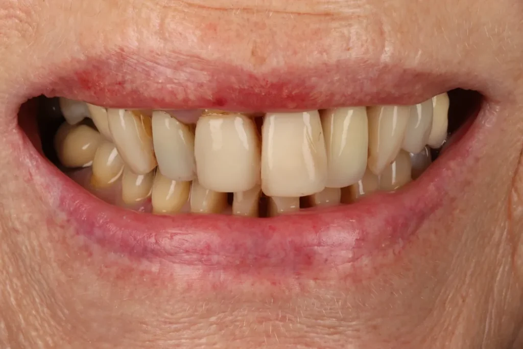 Before Full Mouth Rehab treatment at The Dental Edit