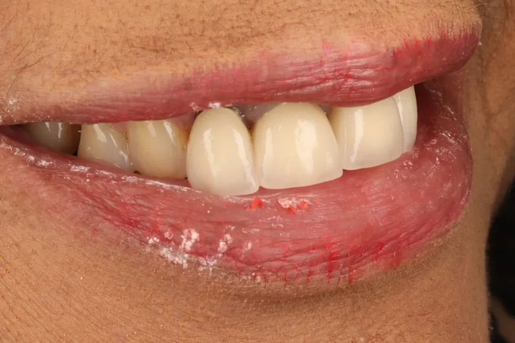 Before Full Mouth Rehab treatment at The Dental Edit