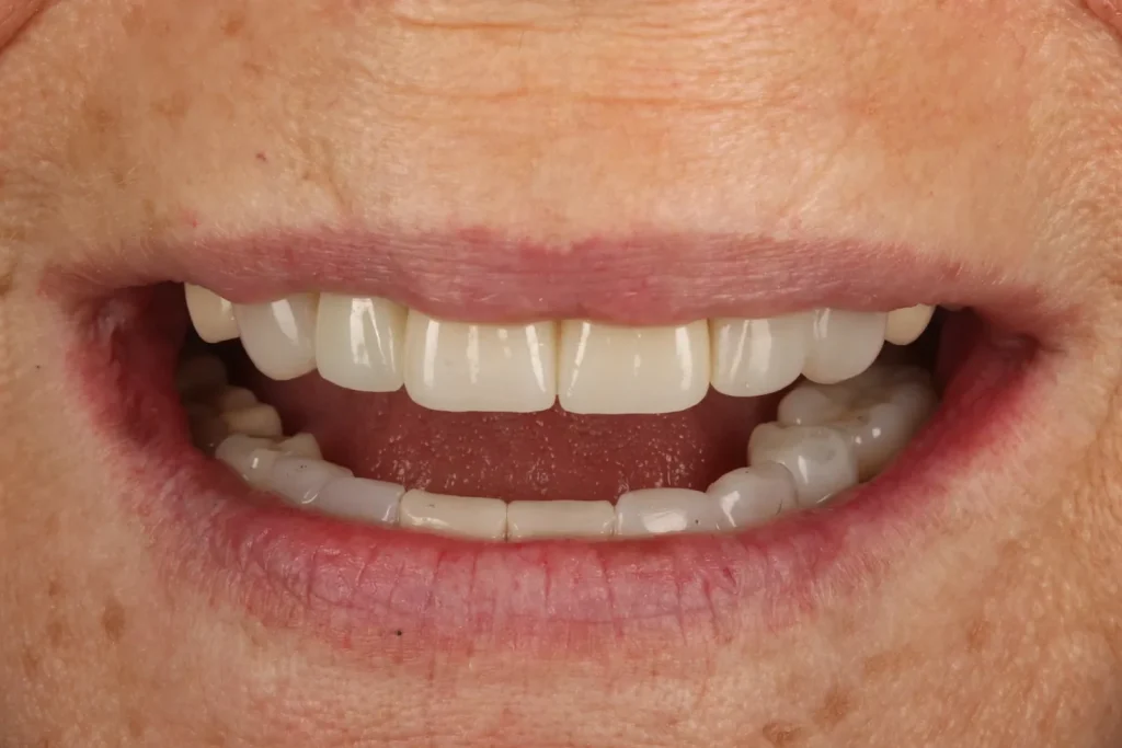 After Full Mouth Rehab treatment at The Dental Edit