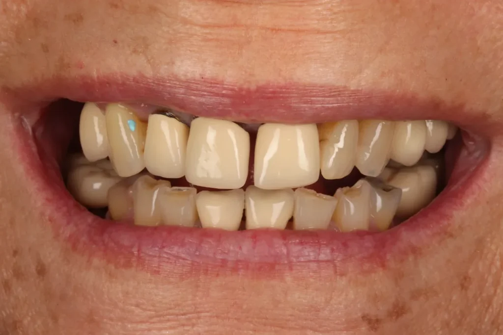 Before Full Mouth Rehab treatment at The Dental Edit