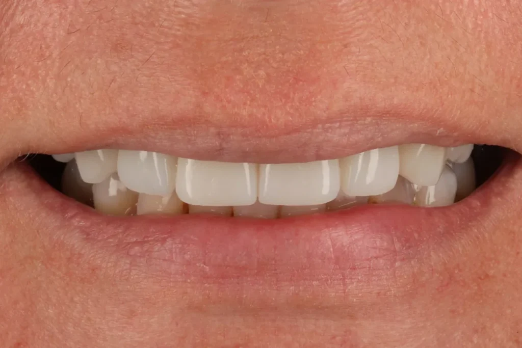 After Full Mouth Rehab treatment at The Dental Edit