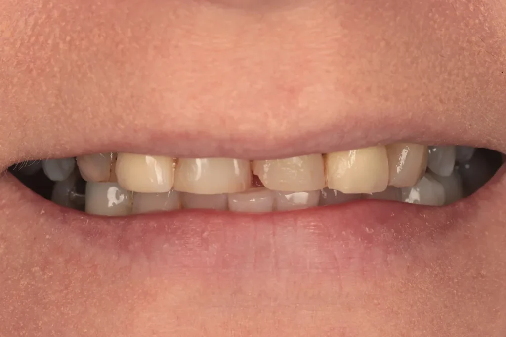 Before Full Mouth Rehab treatment at The Dental Edit