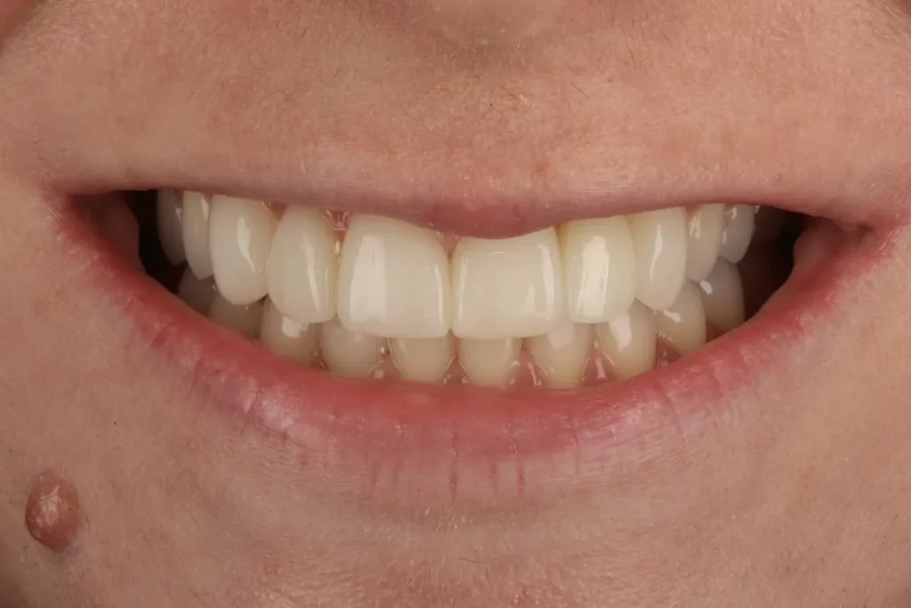 After Missing Tooth Bridge and Composite Bonding treatment at The Dental Edit