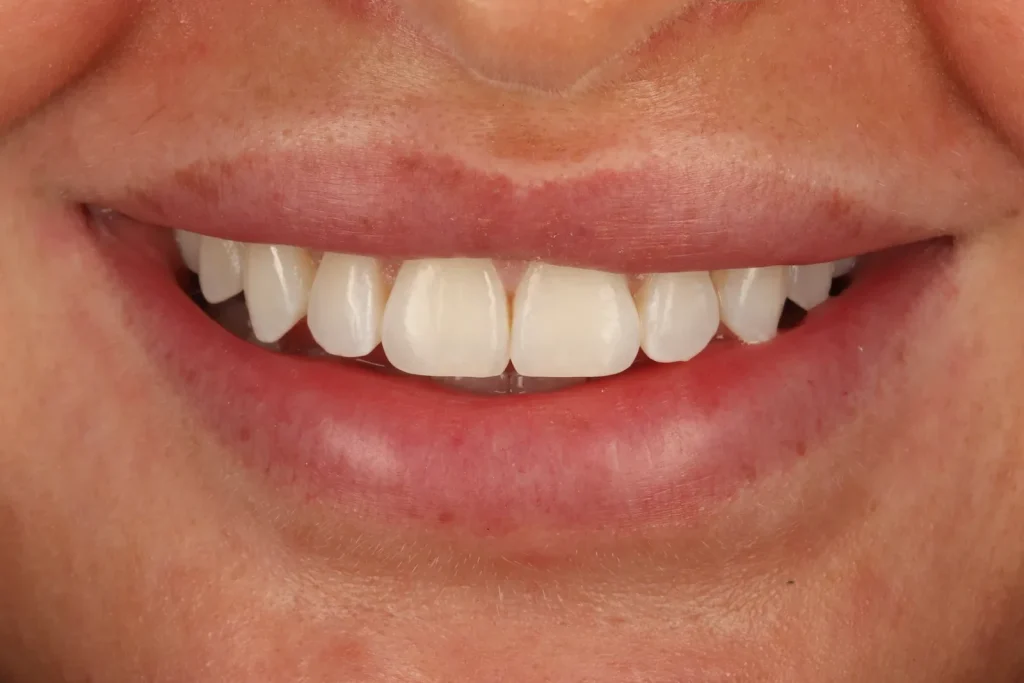 After Orthodontics 1 – Smile treatment at The Dental Edit
