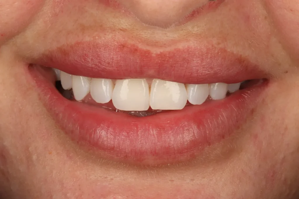 Before Orthodontics 1 – Smile treatment at The Dental Edit