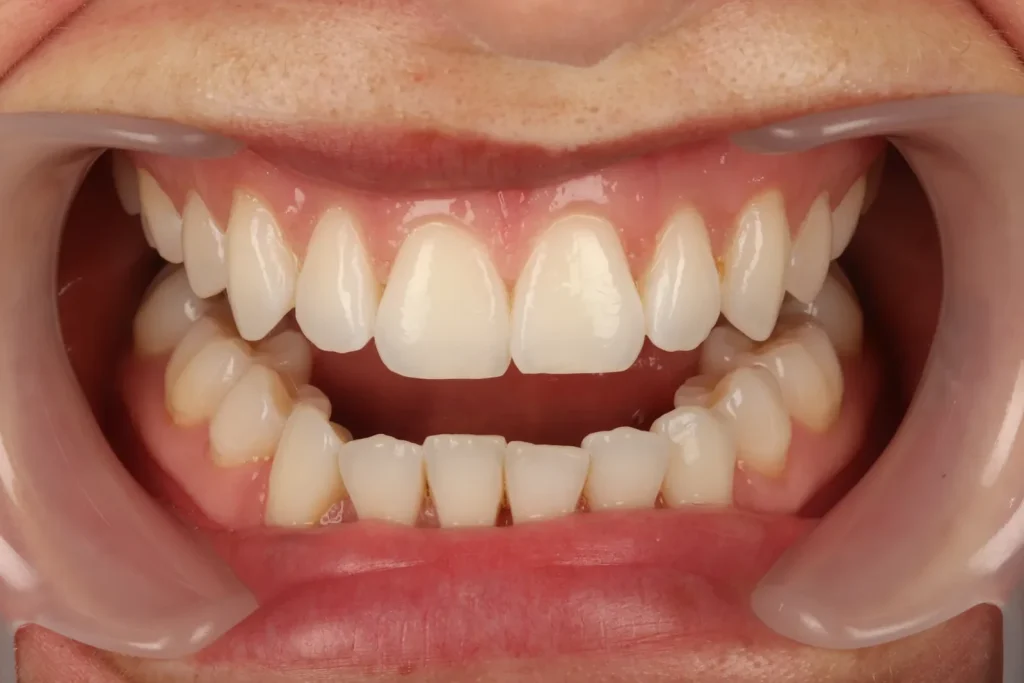 Before Orthodontics treatment at The Dental Edit