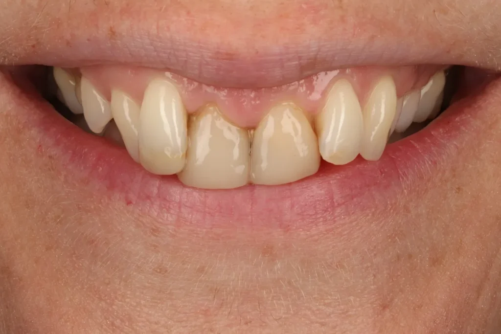 Before Veneers treatment at The Dental Edit