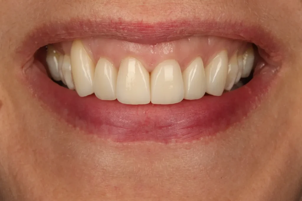 After Veneers treatment at The Dental Edit