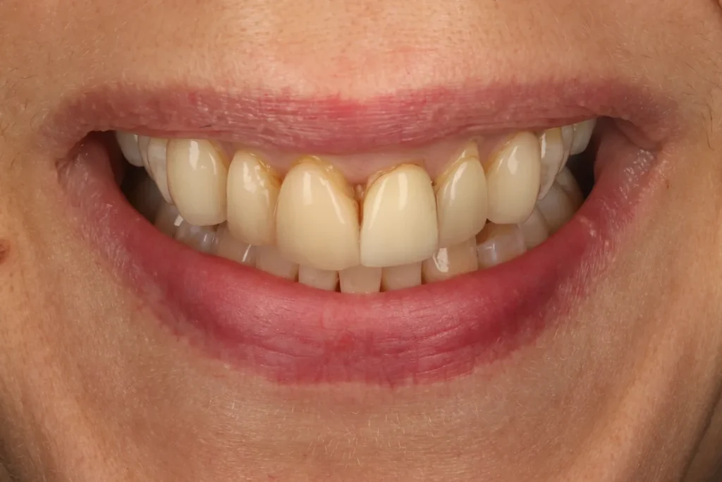 Before Veneers treatment at The Dental Edit