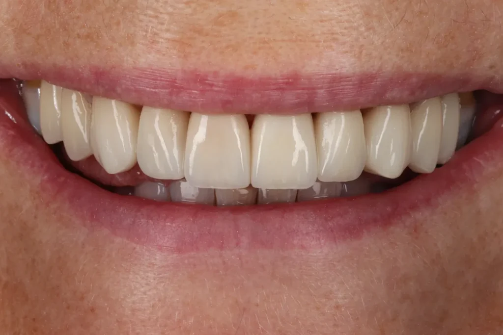 After Veneers treatment at The Dental Edit