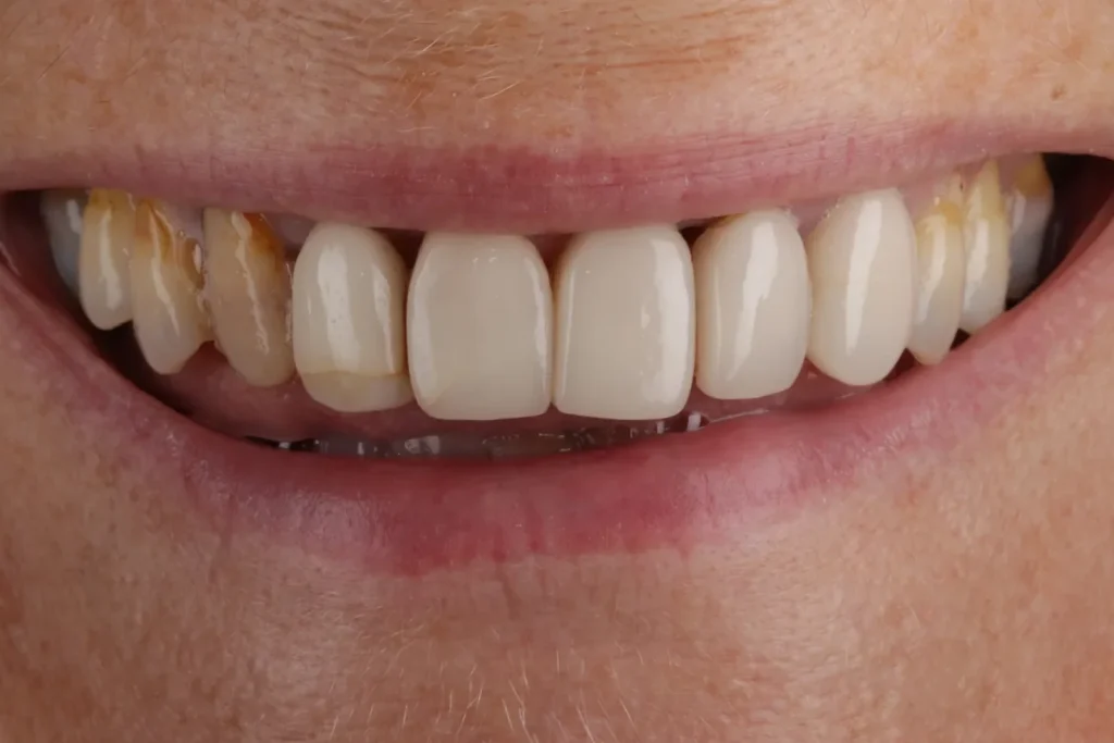 Before Veneers treatment at The Dental Edit